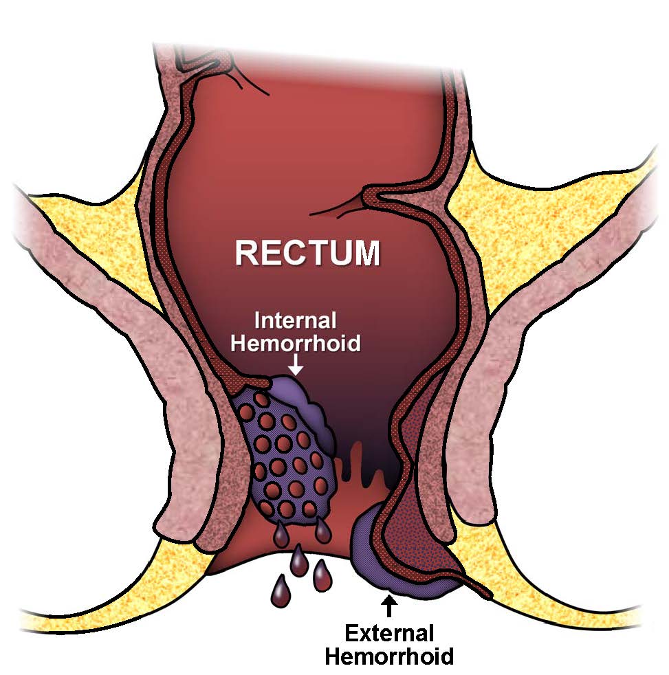 Non-Surgical Remedies for Hemorrhoid