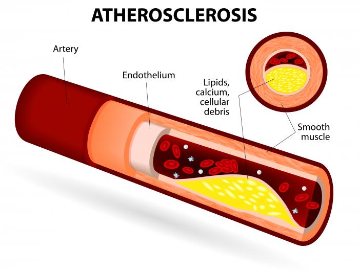 How Generic Viagra Cures Atherosclerosis