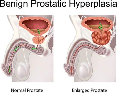 Cialis Medication for Benign Prostatic Hyperplasia (BPH)