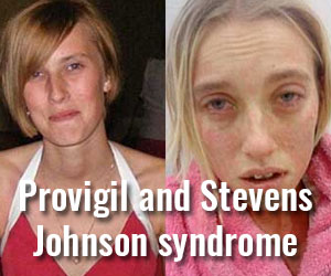 Provigil Medication for Steven-Johnson Syndrome (SJS)